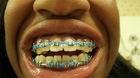 braces power chain entire mouth.